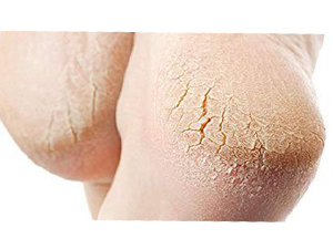 cracked dry heel