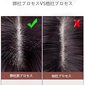手植え手術：渦巻き