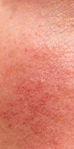 rosocea led face mask light therapy