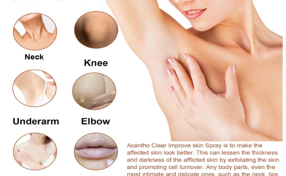 acanthosis nigricans therapy oil