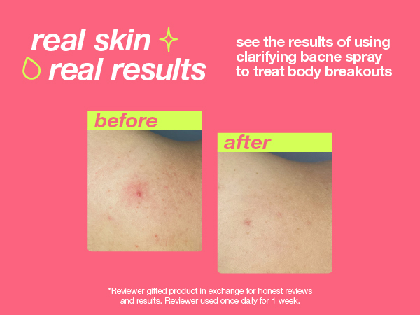 dermalogica clear start clarifying bacne spray back body acne treatment toner spray