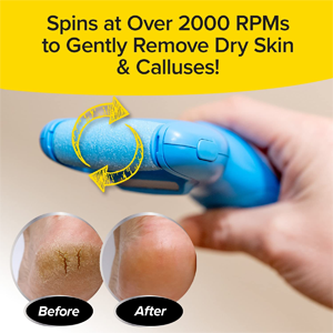 Cordless Motorized Callus Remover