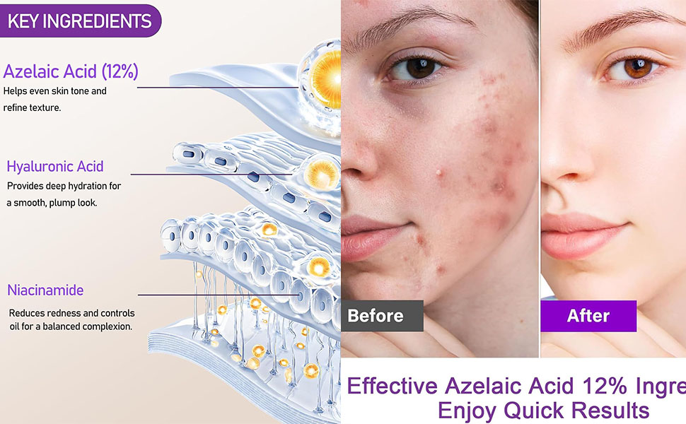 FUNI Azelaic Acid Serum, Booster 12% Azelaic Acid Cream, Hyaluronic Acid Serum & Niacinamide for Face, Facial Cream, Balance Excess Sebum,Smoothing Skin and Blemish,Pore Cleansing 1pcs 25 Unclog pores, reduce pore congestion, and improve pore size with our serum.