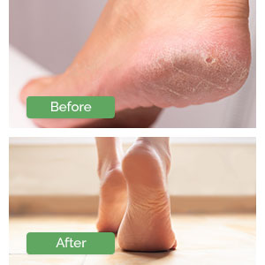 treats cracked heels