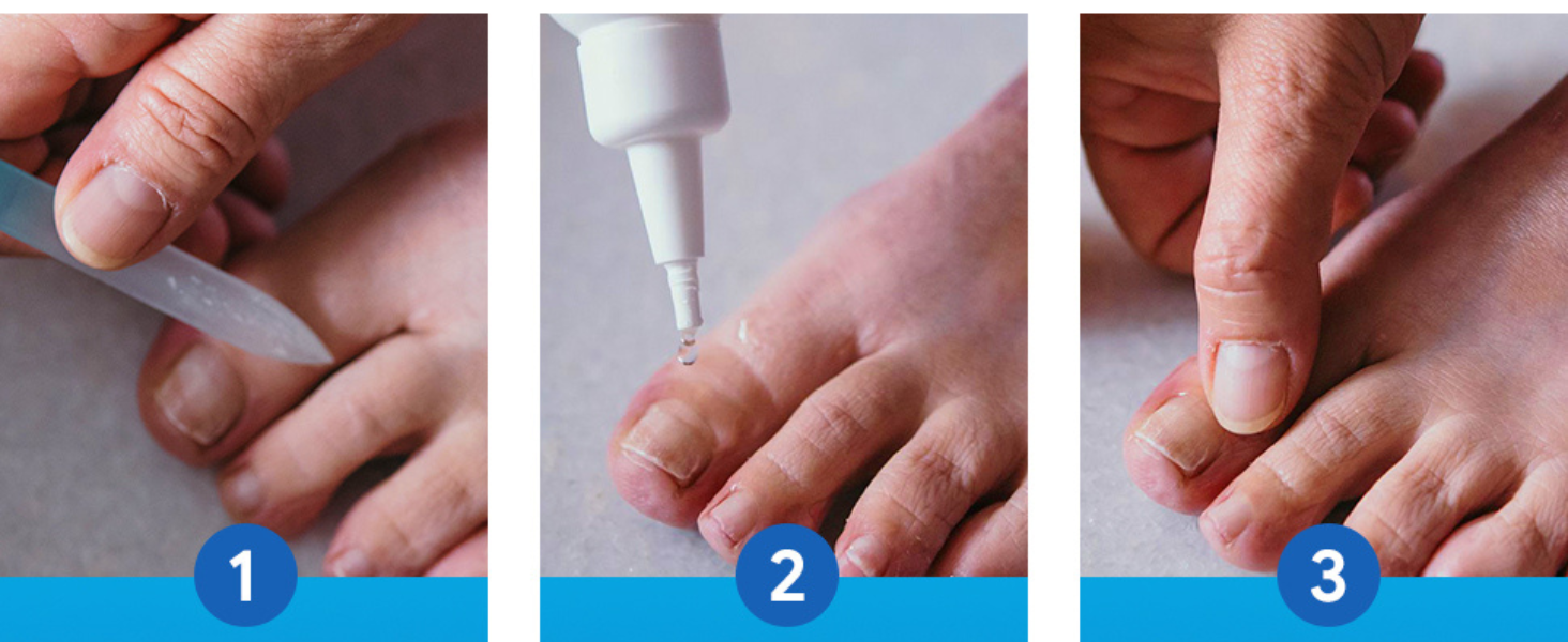 nail fungus