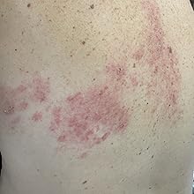 Shingles rash day 7