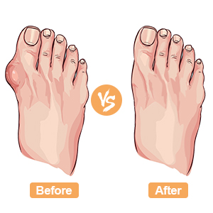 bunion corrector for women