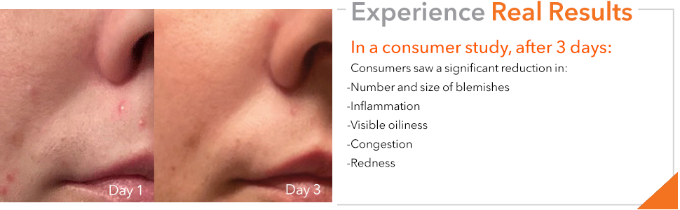 DRx Blemish Solutions Acne Eliminating Gel