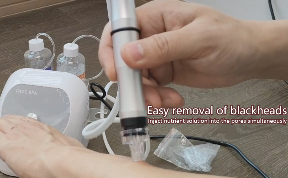 Easy removal of blackheads