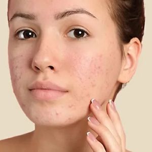 For acne and spots