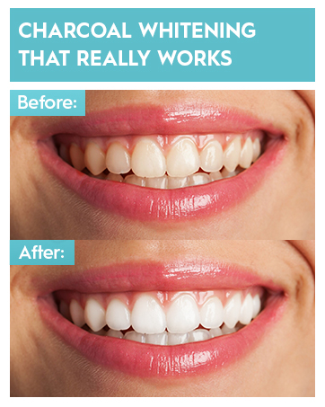 Teeth whitening before and after comparison. Top image shows slightly yellowed teeth, bottom image displays noticeably whiter teeth. Text claims 'Charcoal whitening that really works'.