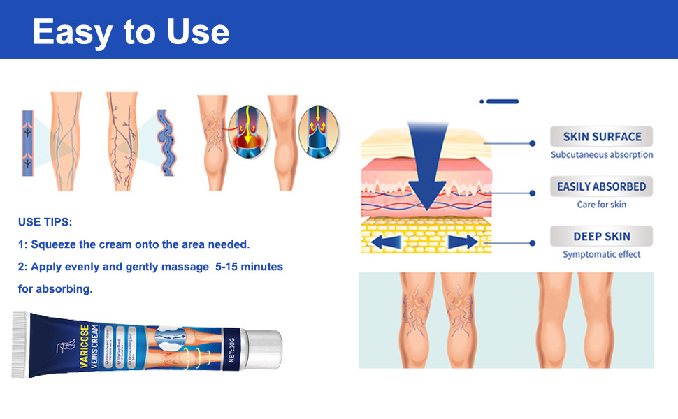 Varicose Vein Relief Cream