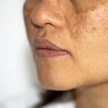 Reduces Hyperpigmentation