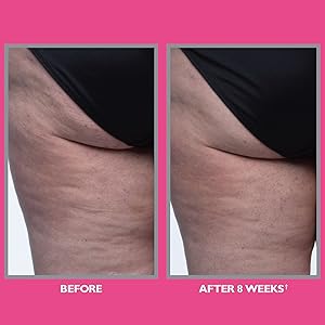 Peter Thomas Roth, FIRMx Tight & Toned Cellulite Treatment, suggested usage, before and after, b&a