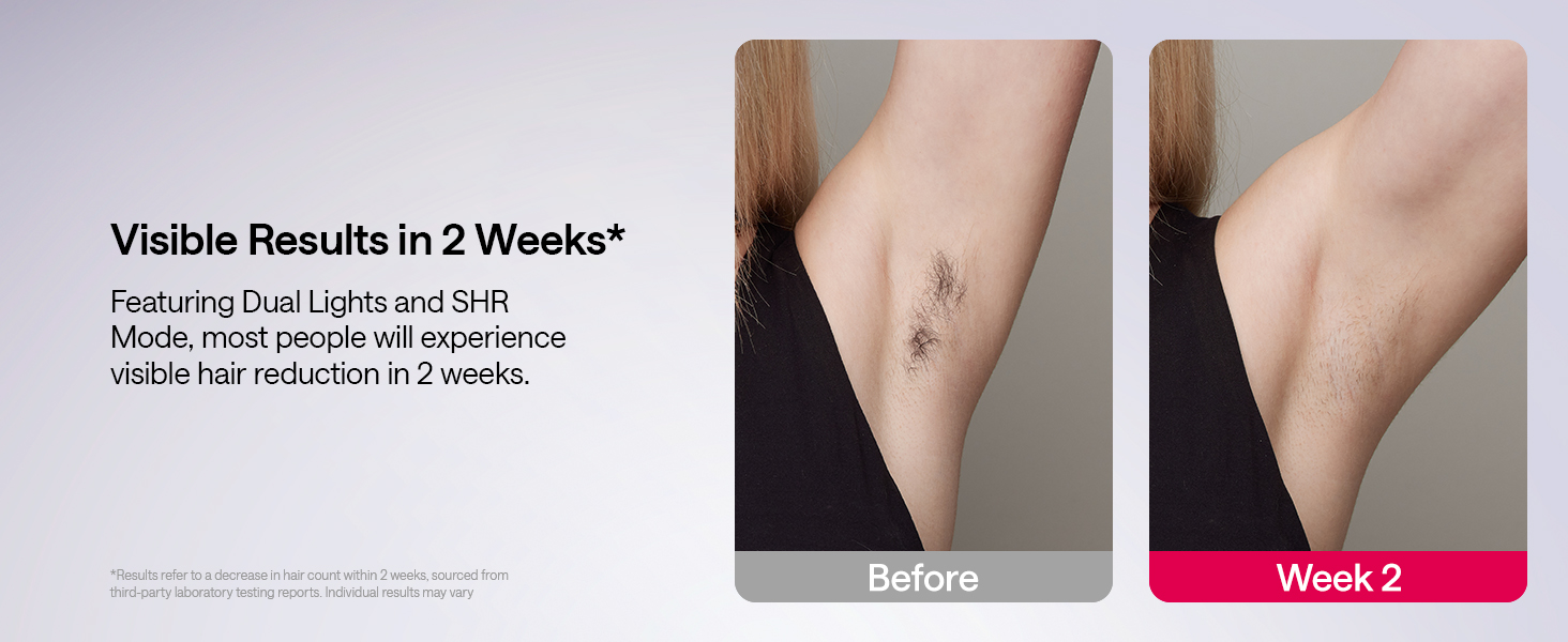  Laser Hair Removal Device