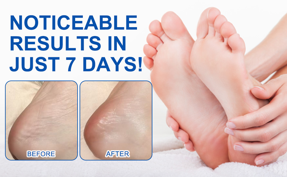 60% Urea Cream Stick with Salicylic Acid 2%