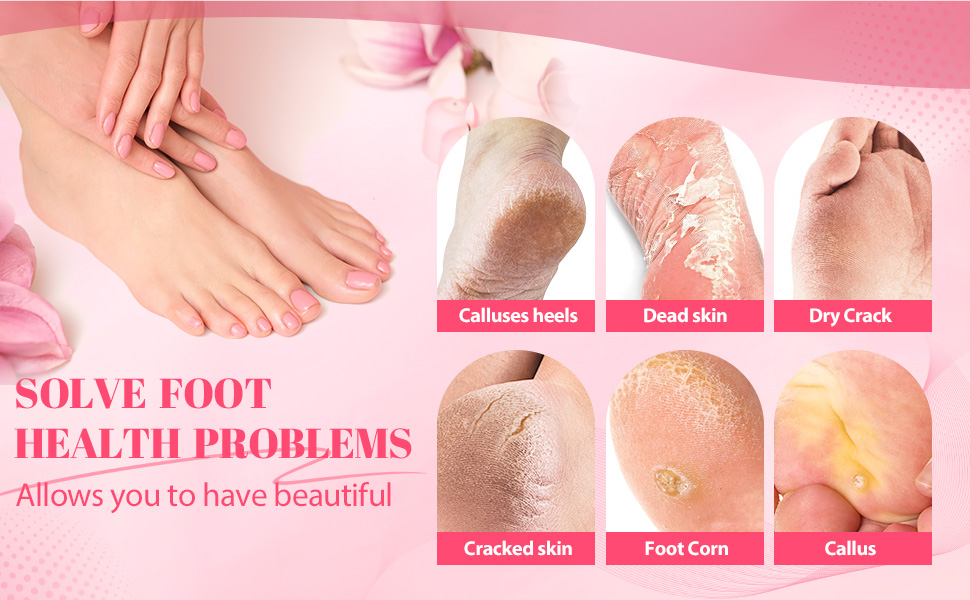 Electric callus remover for feet