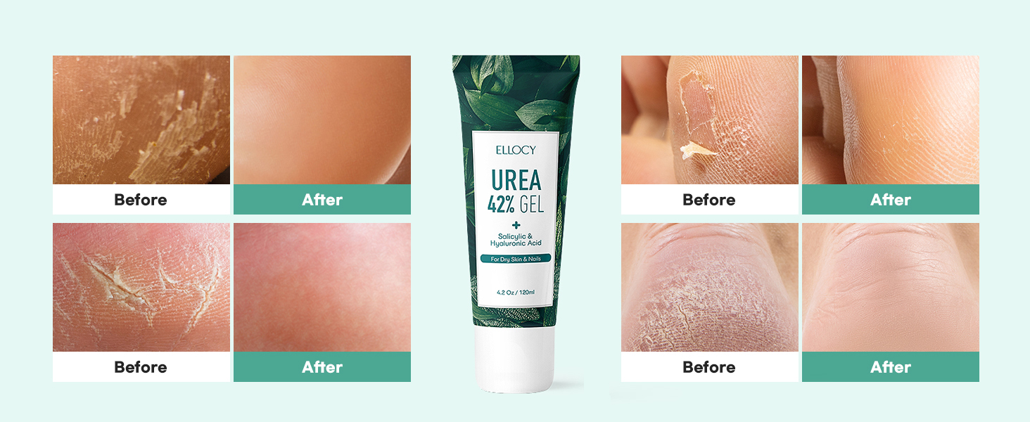 urea cream 40 percent for feet gel