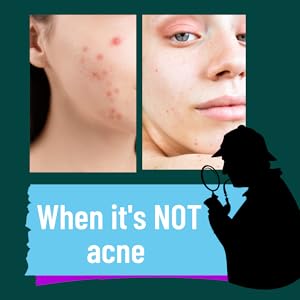When it's Not Acne