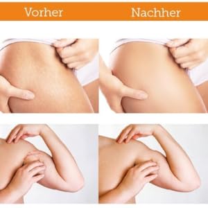 stretch mark