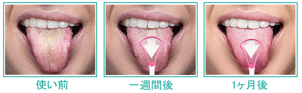 Amazon 舌ブラシ 5本セット したみがき ブラシ シリコン 両面用 舌磨き 舌クリーナー 口臭ケア 舌みがき 舌苔清掃 3色 2本青い 2本 ピンク 1本グリーン Fosspick 舌クリーナー 通販