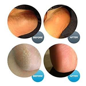 Voet bestand likdoorns voetverzorging mes machine pedicure set voeten verzorging gebarsten hielen dode huid  