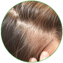 THINNING HAIR