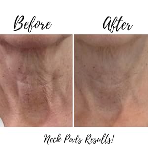 chest wrinkle turkey neck fine like treatment scar treatment 