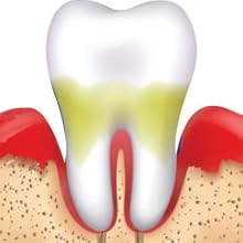 mouthwash for pyorrhoea,teeth whitening mouthwash,best mouthwash to buy,herbal mouthwash