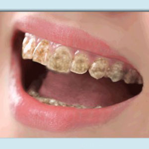 teeth whitening pen 