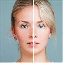 Avocado and Tea Tree Oil 