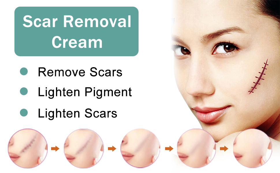 Scar Cream,Scar Removal,Scar Treatment,Scar Removal Cream