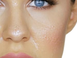 tomato gel for oily skin