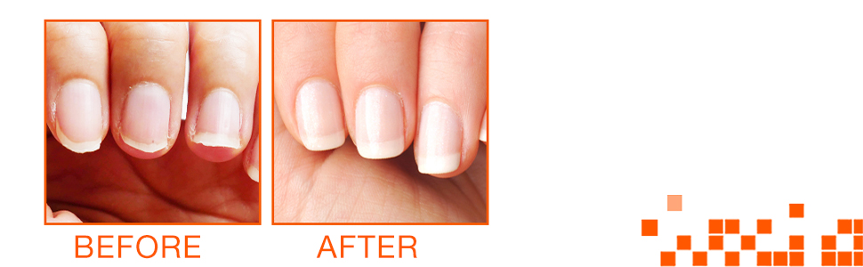 Nail Tek Nail Recovery Kit & Keratin Enriched Nail Treatment Oil Bundle