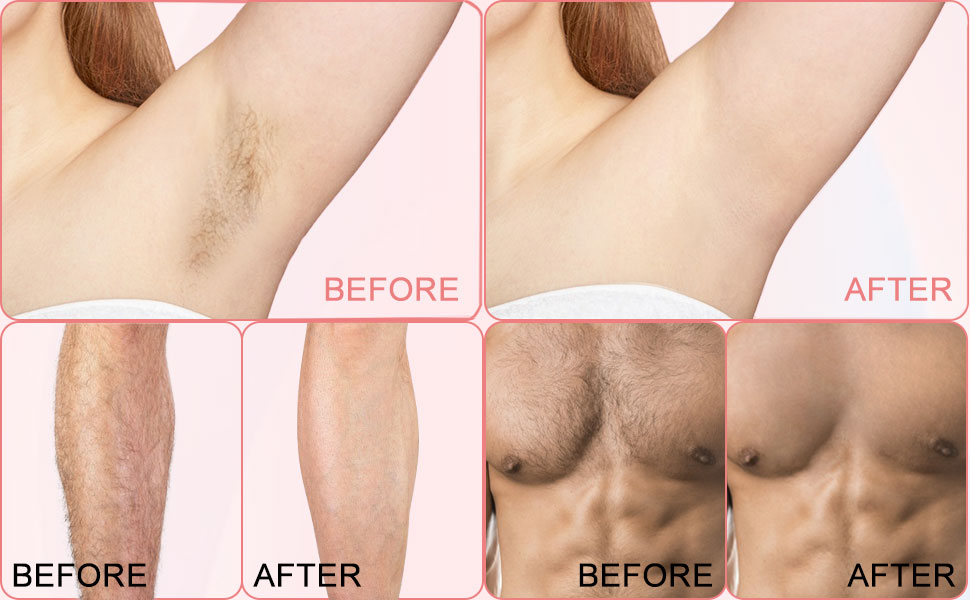 facial hair removal cream for women