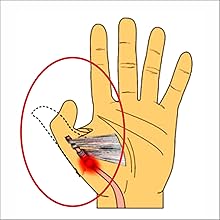 Trigger Thumb ,Irufa,thumb,wrist,splint,brace,wrap,support,spica,stabilizer,breathable