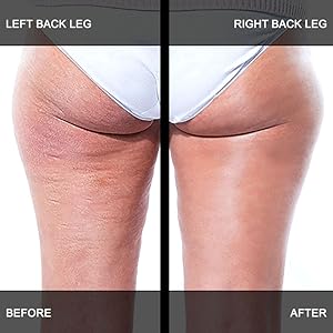 adonia legtone cellulite cream before and after