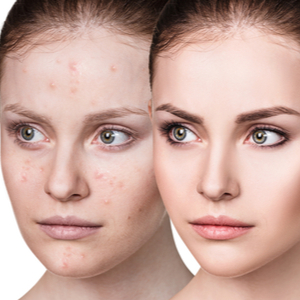 Unclog Pores and Prevent Future Breakouts