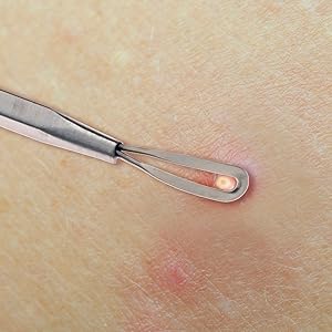 Beaute Galleria Double Loop Blackhead Remover Pimple Extractor Acne Comedone Blemish Removal Tool