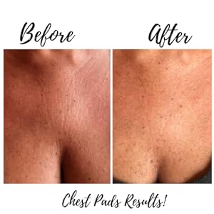 Before and after real chest wrinkle results