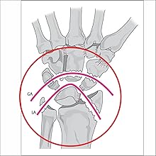 Wrist Dislocation ,Irufa,thumb,wrist,splint,brace,wrap,support,spica,stabilizer,breathable