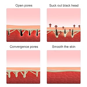 blackhead removal tool