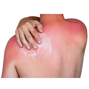 sunburn itch and pain relief aftercare aftersuncare