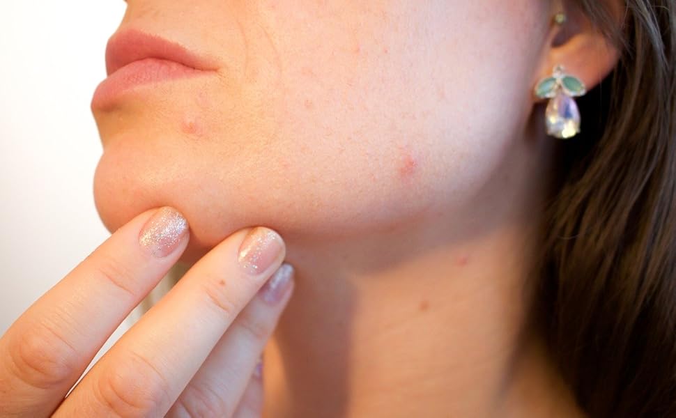 bouton visage,peau grasse acneique,acne traitement,acnée adulte,acne visage,bouton de fievre,acnée