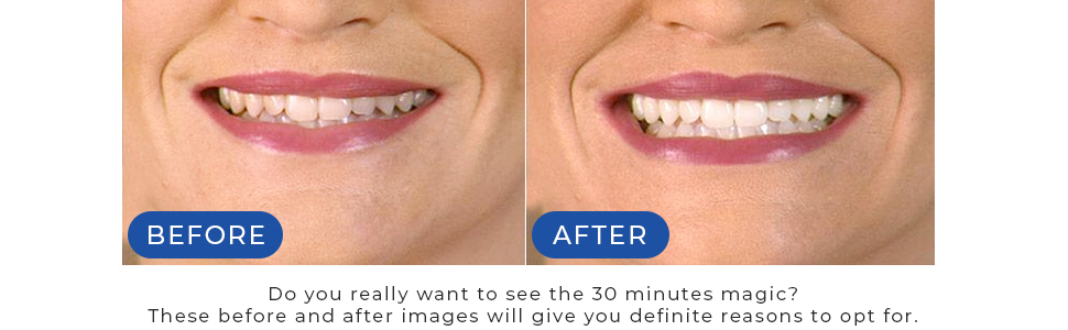 Amazon Com Luster Premium White Pro Sonic Dental Teeth Whitening System With Power Sonic Toothbrush Beauty Personal Care Amazon Com Luster Premium White Pro Sonic Dental Teeth Whitening System With Power Sonic Toothbrush Beauty Personal Care