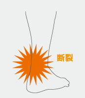 ザムスト アキレス腱断裂