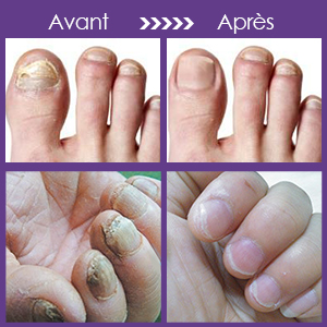 Kit De Traitement Des Champignons Des Ongles Luckyfine Traitement Antifongique Pour Les Ongles Solution Antifongique Naturelle Contre La Mycose Des Ongles Favorise La Repousse D Ongles Sains Amazon Fr Beaute Et Parfum