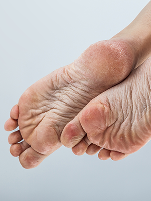 Hornhaut ist problematisch