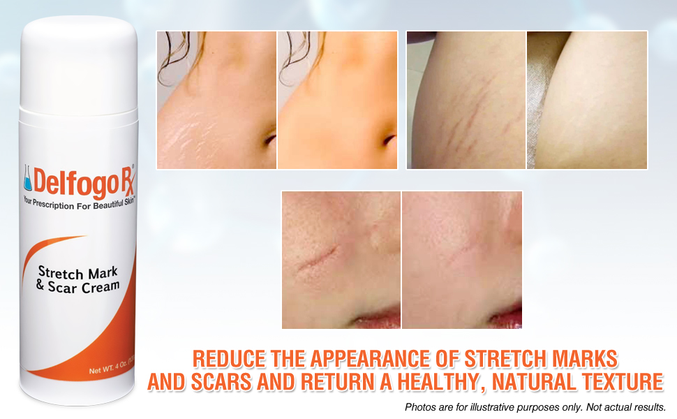 Amazon Com Delfogo Rx Stretch Mark Scar Cream Fortified With Vanistryl Eyeliss Essenskin Syn Coll And Hyaluronic Acid To Diminish Skin Damage And Discoloration Beauty