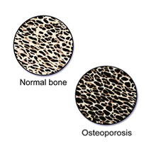 Osteoporosis